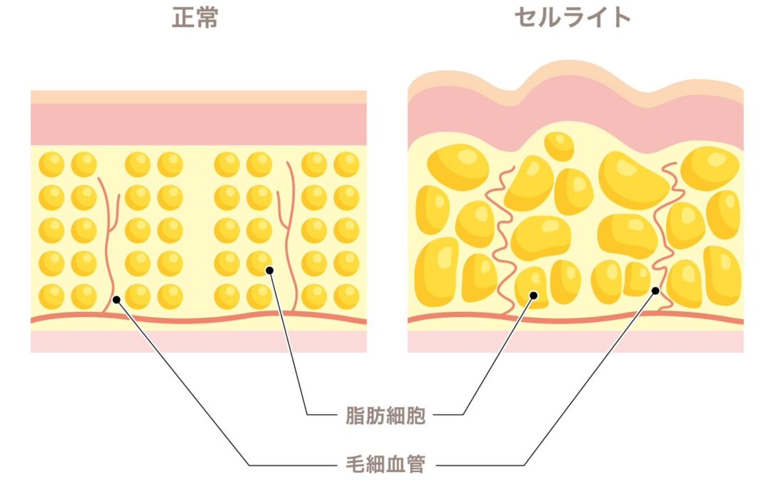 エステじゃ消えない？セルライトの秘密