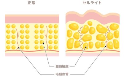 エステじゃ消えない？セルライトの秘密